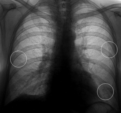 Особенности рентгеновских снимков при пневмонии